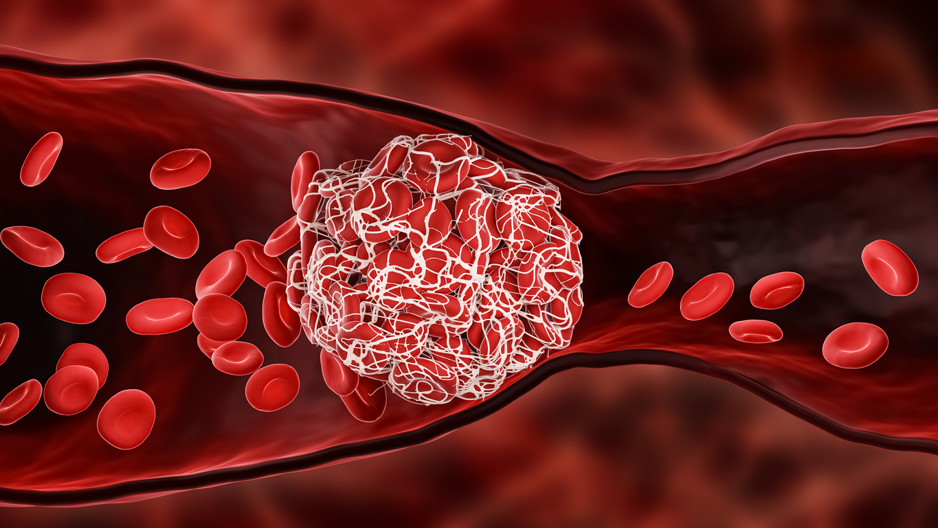 Coágulo sanguíneo ou trombo bloqueando o fluxo de glóbulos vermelhos dentro de uma artéria ou uma ilustração de renderização 3D da veia. Trombose, sistema cardiovascular, medicina, biologia, saúde, anatomia, conceitos patológicos.
